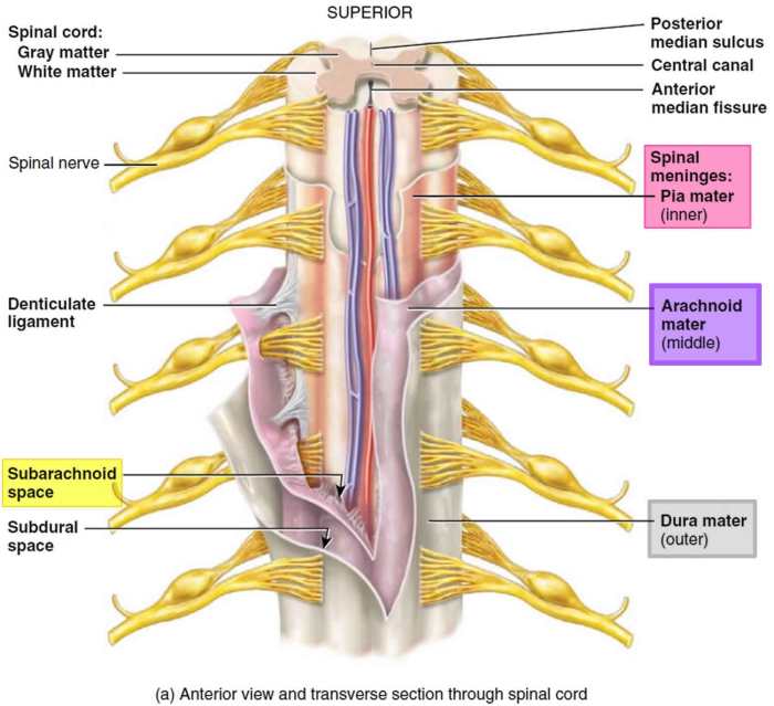 A patient with a neoplasm of the spinal meninges