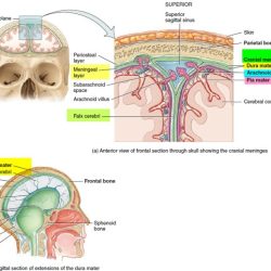 Neoplasms meningioma